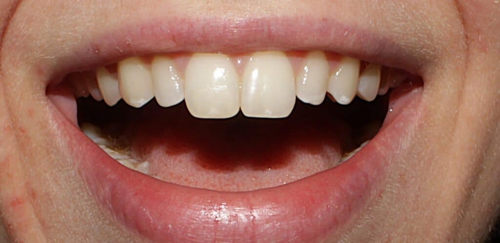 Close-up of smiling mouth showing white, well-aligned upper teeth at Smile Gallery at Westlake Village Dental