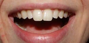 Close-up of smiling mouth showing white, well-aligned upper teeth at Smile Gallery at Westlake Village Dental