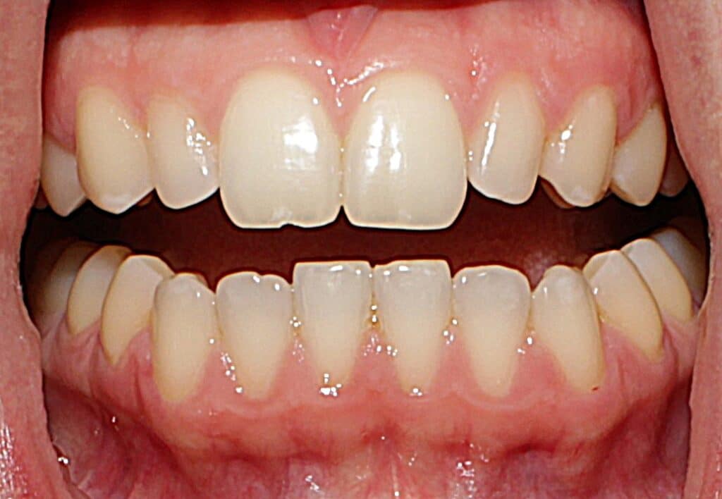 Front view of upper and lower teeth showing spacing and alignment at Smile Gallery at Westlake Village Dental
