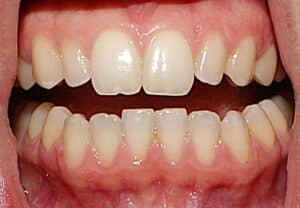 Front view of upper and lower teeth showing spacing and alignment at Smile Gallery at Westlake Village Dental