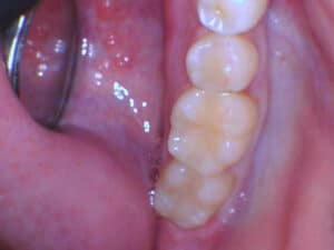 Close-up of lower molars and gum tissue showing dental health at Smile Gallery at Westlake Village Dental