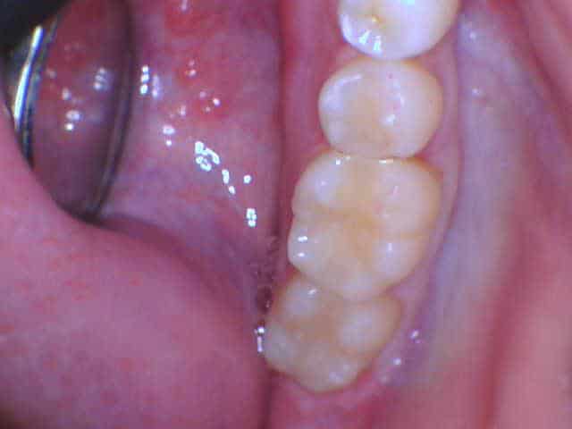 Close-up of lower molars and gum tissue showing dental health at Smile Gallery at Westlake Village Dental