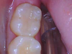 Close-up view of two upper molars showing clean tooth surfaces at Smile Gallery at Westlake Village Dental