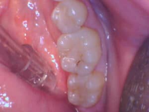 Close-up of molar teeth with minor staining, Smile Gallery at Westlake Village Dental.
