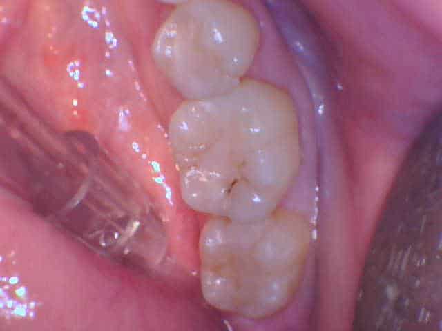Close-up of molar teeth with minor staining, Smile Gallery at Westlake Village Dental.