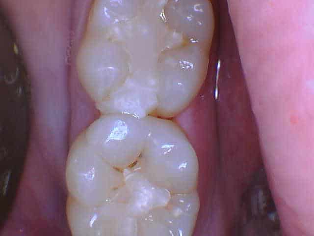Top view of two molar teeth with minor grooves and pits, Smile Gallery at Westlake Village Dental.