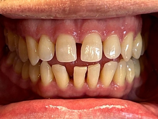 Close-up of teeth with noticeable gaps and alignment details at Smile Gallery at Westlake Village Dental