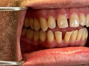 Side view of teeth and gums showing alignment and spacing at Smile Gallery at Westlake Village Dental