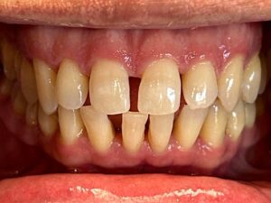 Close-up of upper and lower teeth showing spacing and alignment at Smile Gallery at Westlake Village Dental