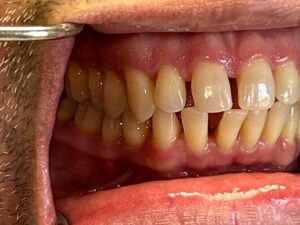 Side view of teeth showing spacing and alignment details at Smile Gallery at Westlake Village Dental