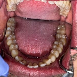 View of upper teeth and palate showing dental arch and alignment at Smile Gallery at Westlake Village Dental