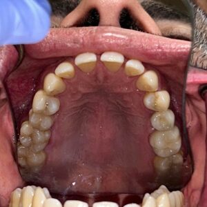 View of upper teeth and palate showing dental arch and alignment at Smile Gallery at Westlake Village Dental
