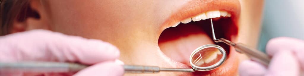 WestlakeVillageDentist_CavityFillings