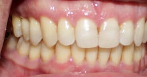 Side view of straight, white teeth with healthy gums at Smile Gallery at Westlake Village Dental