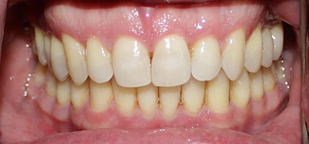 Close-up of bright, straight teeth with healthy gums at Smile Gallery at Westlake Village Dental