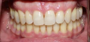 Close-up of bright, straight teeth with healthy gums at Smile Gallery at Westlake Village Dental