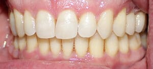 Close-up of upper and lower teeth showing spacing and alignment at Smile Gallery at Westlake Village Dental