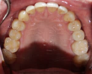 View of upper teeth and palate showing dental arch and alignment at Smile Gallery at Westlake Village Dental