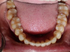 View of lower teeth and tongue showing dental structure and alignment at Smile Gallery at Westlake Village Dental