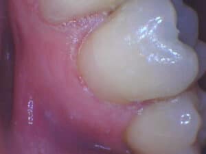 Close-up of gumline and teeth showing healthy tissue and enamel at Smile Gallery at Westlake Village Dental