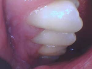 Side view of healthy white teeth and gums highlighting dental alignment at Smile Gallery at Westlake Village Dental