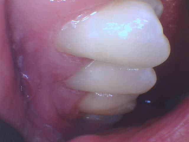 Side view of healthy white teeth and gums highlighting dental alignment at Smile Gallery at Westlake Village Dental