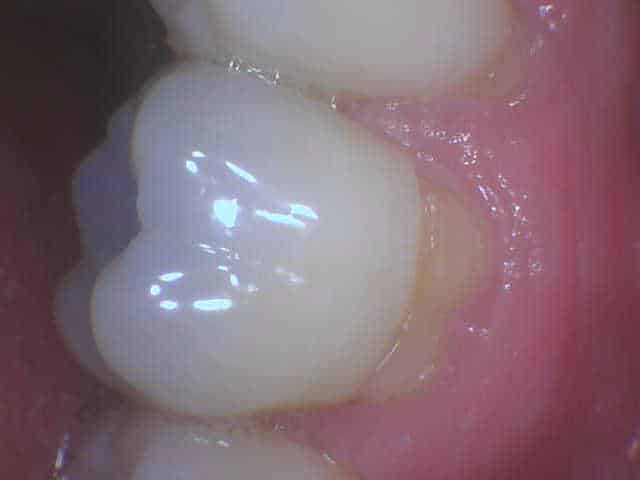 Close-up of healthy molar tooth with smooth white surface, Smile Gallery at Westlake Village Dental.